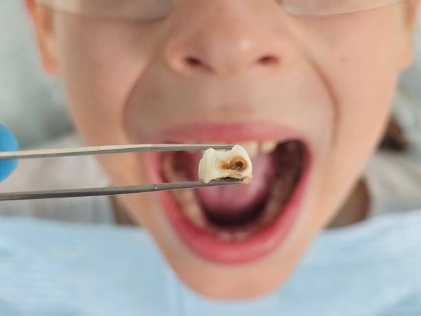 Tooth Infection Emergency Dentist in OK